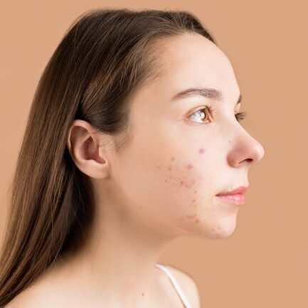 Close-up profile portrait of a teenage girl with acne against a neutral background.